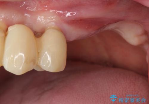 [入れ歯にしたくない] 臼歯部インプラント補綴の症例 治療前