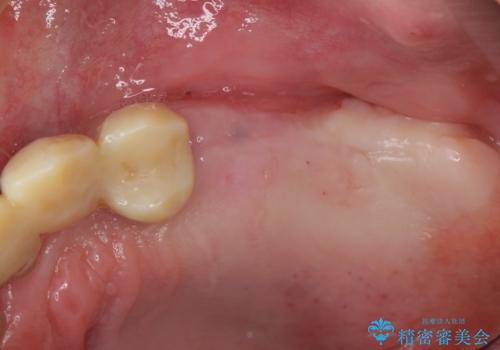 [入れ歯にしたくない] 臼歯部インプラント補綴の治療前
