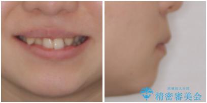 気になる八重歯を治したい ワイヤー装置での抜歯矯正の治療前(顔貌)