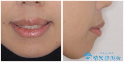 前歯のデコボコを治したい 費用を抑えた抜歯矯正の治療前(顔貌)