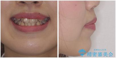 口元をスッキリと ワイヤーでの抜歯矯正の治療前(顔貌)