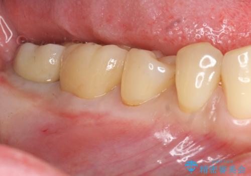 抜歯時歯槽堤保存術を用いた骨造成・インプラント治療の治療後