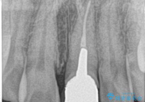 前歯が黒くなってきた。オールセラミッククラウンの治療前