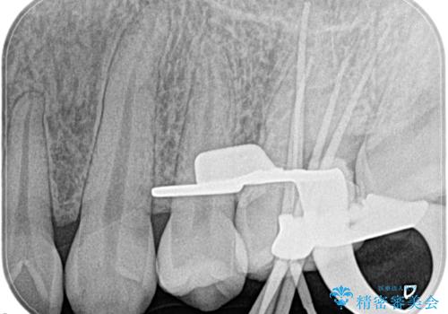 奥歯が痛い。根管治療の治療後