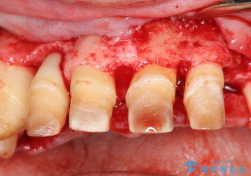 インプラントを用いた歯周病全顎治療
