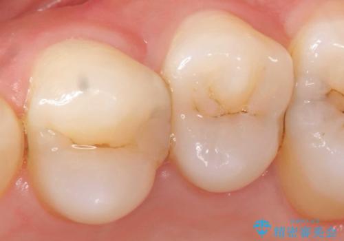 X線撮影によりわかる、内在する虫歯治療の症例 治療前
