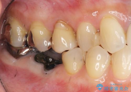 セラミックブリッジによる審美・咬合機能回復治療の治療前
