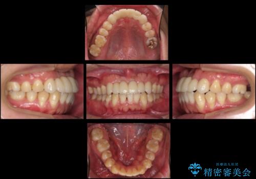 前歯ブリッジのやりかえ　下の歯のがたつき　銀歯を全てセラミックにの症例 治療後