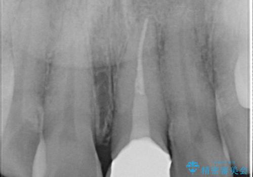 前歯が黒くなってきた。オールセラミッククラウンの治療後