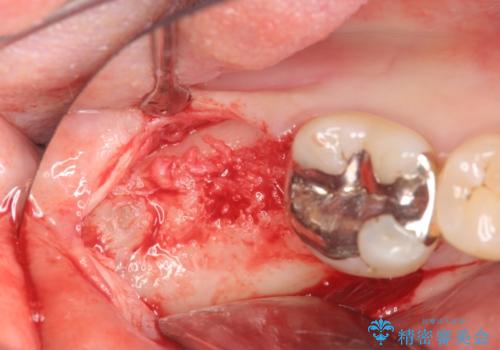 抜歯時歯槽堤保存術を用いた骨造成・インプラント治療の治療中