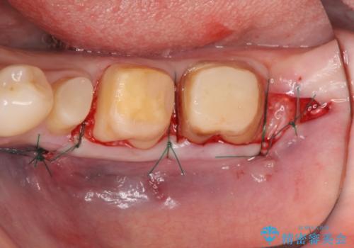 歯ぐきからの出血 歯周外科による改善の治療中
