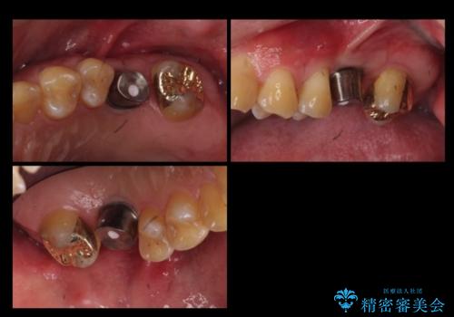 上の奥歯のインプラント、全体的な虫歯治療の治療中