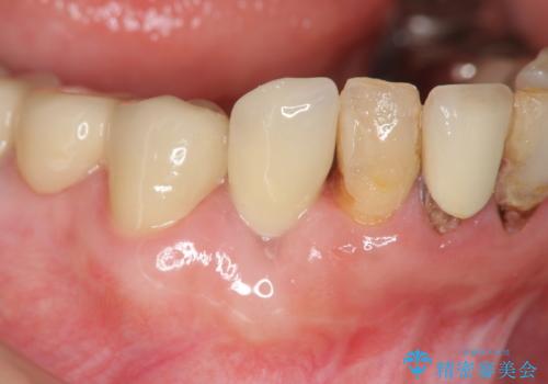 吸収した骨の再生 前歯部インプラント治療の症例 治療後