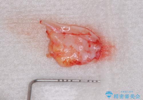 前歯のブリッジが気に入らない 歯肉移植術を併用した前歯のブリッジの治療前