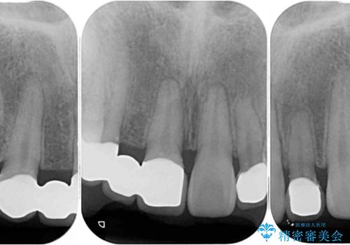 欠損歯と矮小歯　矯正治療と前歯のセラミック治療の治療後