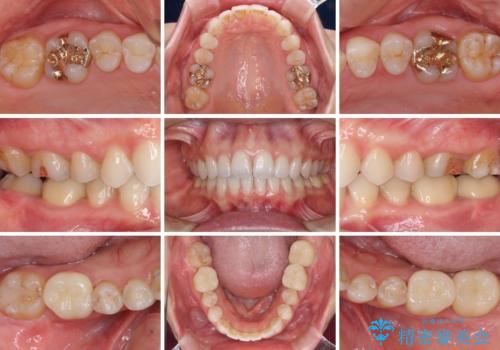 深い咬み合わせと奥歯のむし歯　総合歯科治療の治療後