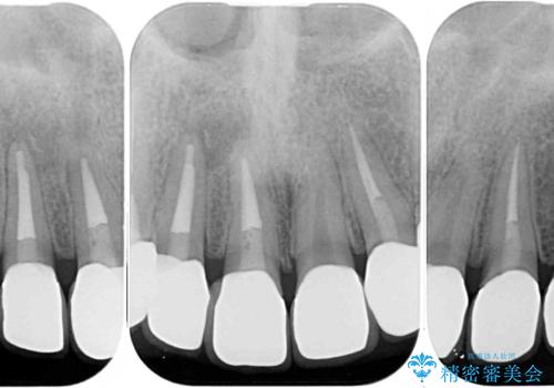 継ぎ接ぎだらけの前歯を綺麗にしたい 前歯のオールセラミックの治療後