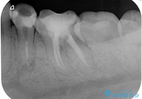 精密根管治療。大臼歯イニシャルケースの治療後