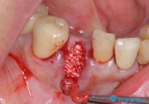 吸収した骨の再生 前歯部インプラント治療の治療中