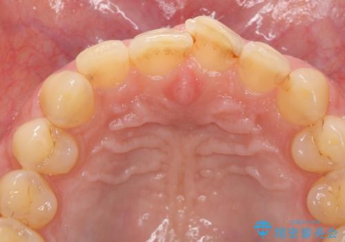 [[セラミック治療]]  溶けて形の悪くなった歯を改善したいの治療前