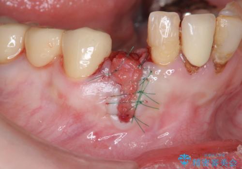 吸収した骨の再生 前歯部インプラント治療の治療中