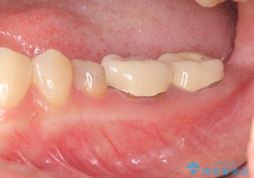 深い虫歯　歯周外科を併用した精度の高い補綴治療の症例 治療前