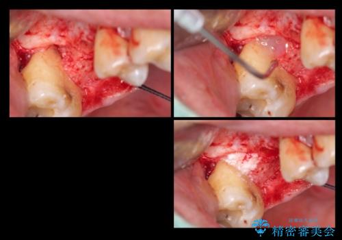 上の奥歯のインプラント、全体的な虫歯治療の治療中