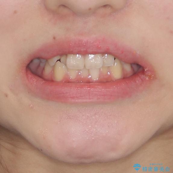 前歯のクロスバイト　メタル装置での矯正治療の治療前（顔貌）