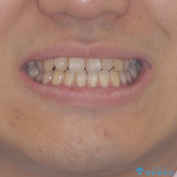 下顎前歯と上顎の部分矯正の治療前（顔貌）