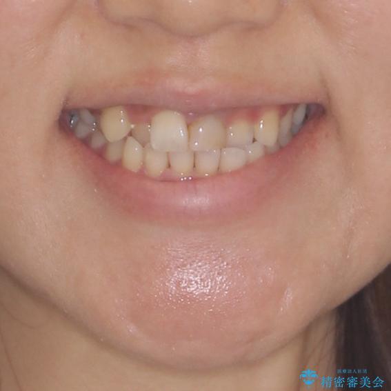 前歯のクロスバイトと変色した歯　ワイヤー矯正とセラミック治療の治療前（顔貌）