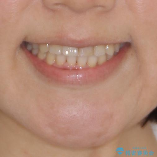 前歯のクロスバイトと変色した歯　ワイヤー矯正とセラミック治療の治療後（顔貌）