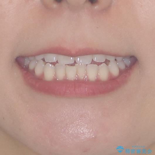 前歯のオープンバイトを治したい　インビザラインでの矯正治療の治療前（顔貌）