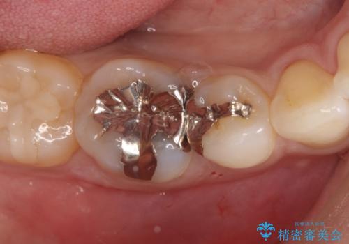 審美性の高いセラミックインレーの症例 治療前