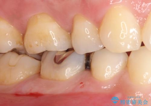 審美性の高いセラミックインレーの治療前