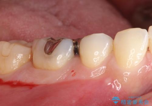 審美性の高いセラミックインレーの治療前