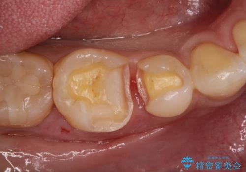審美性の高いセラミックインレーの治療中