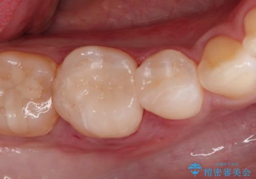 審美性の高いセラミックインレーの症例 治療後