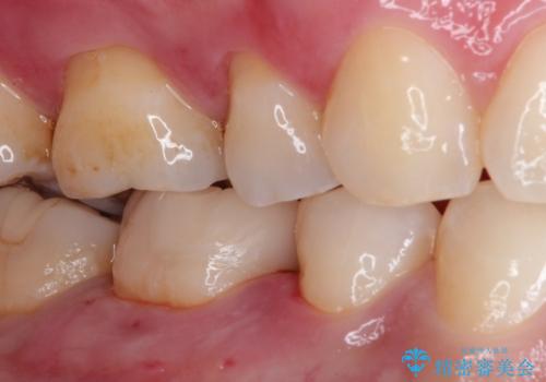 審美性の高いセラミックインレーの治療後