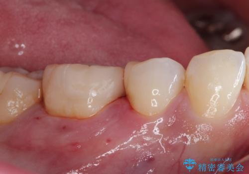 審美性の高いセラミックインレーの治療後