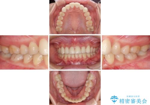 継ぎ接ぎだらけの前歯を綺麗にしたい 前歯のオールセラミックの治療後