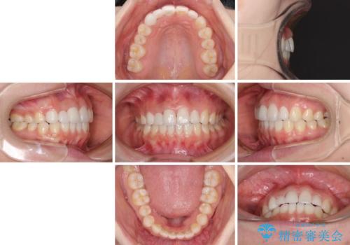 欠損歯と矮小歯 矯正治療と前歯のセラミック治療の治療後
