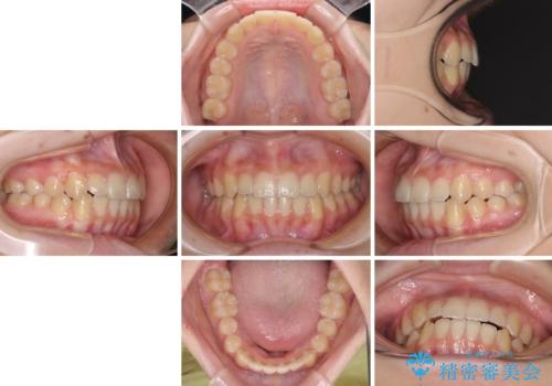 前歯のクロスバイト メタル装置での矯正治療の治療後