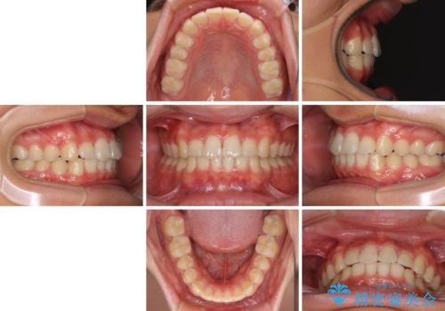 深い咬み合わせとデコボコ ワイヤー矯正で短期治療の治療後