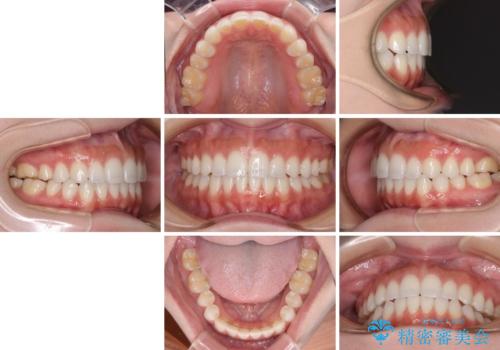 前歯のオープンバイトを治したい インビザラインでの矯正治療の治療後