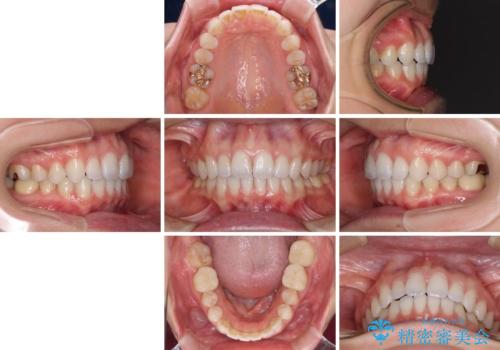 深い咬み合わせと奥歯のむし歯 総合歯科治療の治療後