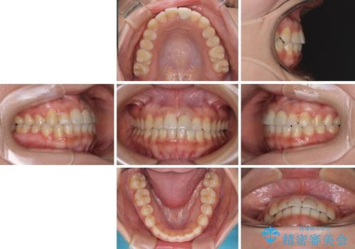 前歯のクロスバイトと変色した歯 ワイヤー矯正とセラミック治療の治療後