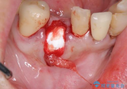 吸収した骨の再生 前歯部インプラント治療の治療中
