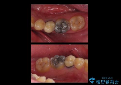 上の奥歯のインプラント、全体的な虫歯治療の治療前