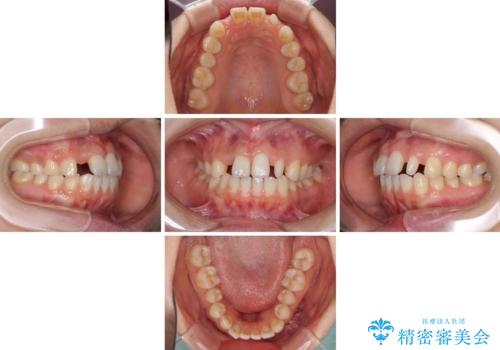 欠損歯と矮小歯 矯正治療と前歯のセラミック治療の治療中
