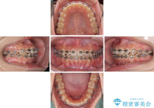 前歯のクロスバイト メタル装置での矯正治療の治療中